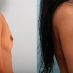 Breast Augmentation before and after photos in Houston, TX, Patient 42556