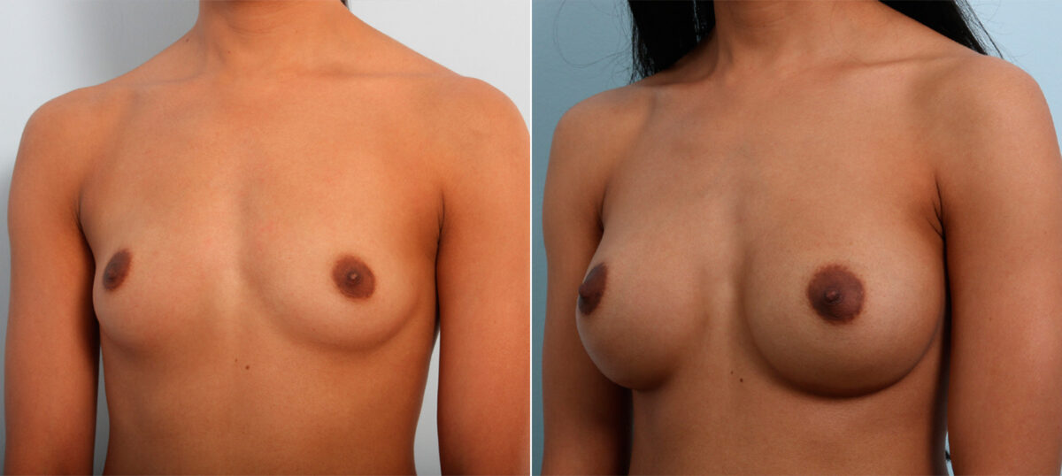 Breast Augmentation before and after photos in Houston, TX, Patient 42556