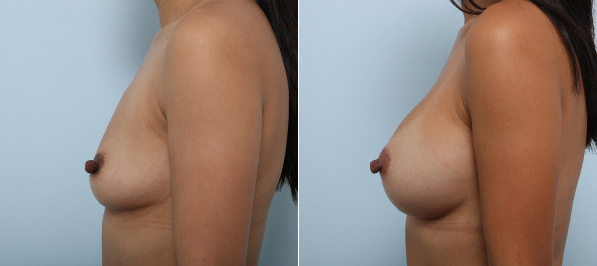 Breast Augmentation before and after photos in Houston, TX, Patient 42891