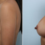Breast Augmentation before and after photos in Houston, TX, Patient 42891