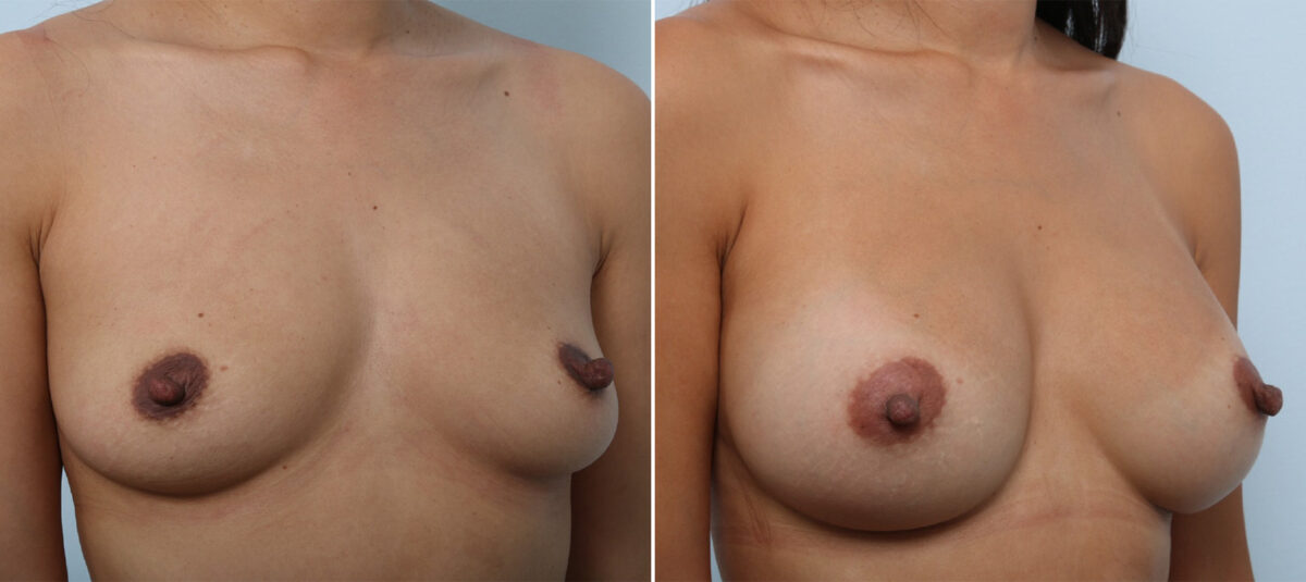 Breast Augmentation before and after photos in Houston, TX, Patient 42891