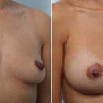 Breast Augmentation before and after photos in Houston, TX, Patient 42891