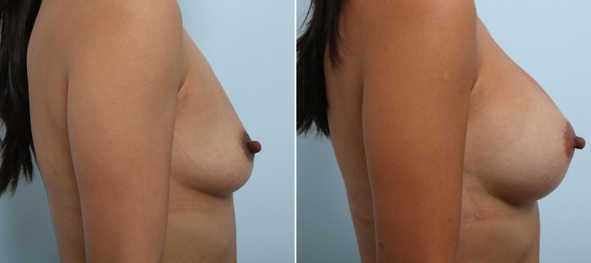 Breast Augmentation before and after photos in Houston, TX, Patient 42891