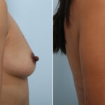 Breast Augmentation before and after photos in Houston, TX, Patient 42891