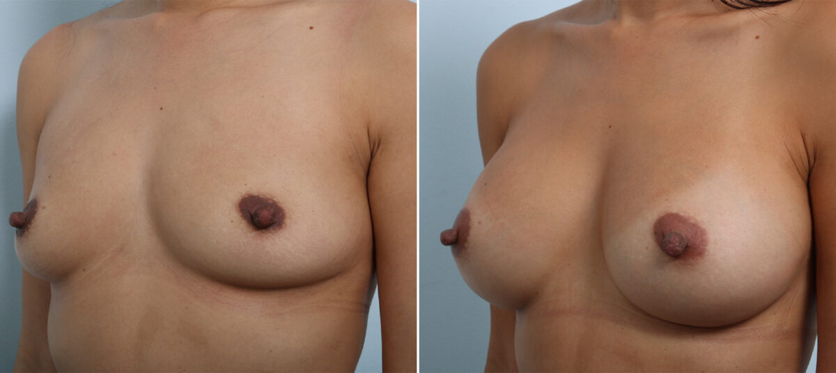 Breast Augmentation before and after photos in Houston, TX, Patient 42891