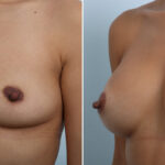 Breast Augmentation before and after photos in Houston, TX, Patient 42891