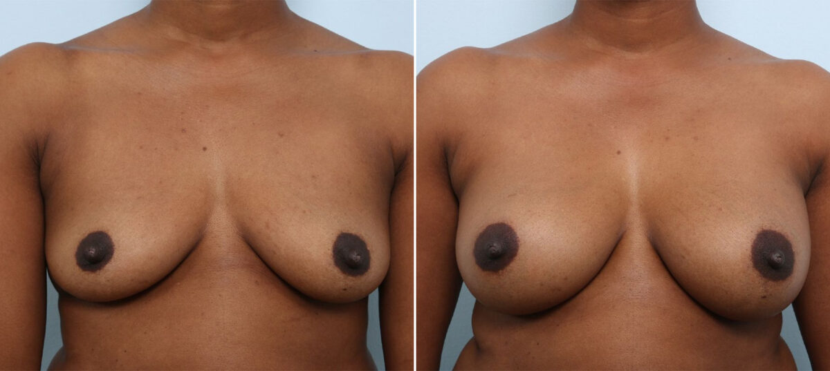 Breast Augmentation before and after photos in Houston, TX, Patient 42912