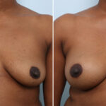 Breast Augmentation before and after photos in Houston, TX, Patient 42912