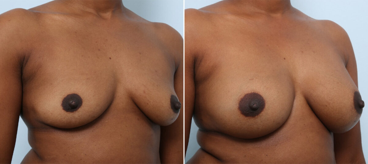 Breast Augmentation before and after photos in Houston, TX, Patient 42912