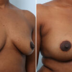 Breast Augmentation before and after photos in Houston, TX, Patient 42912