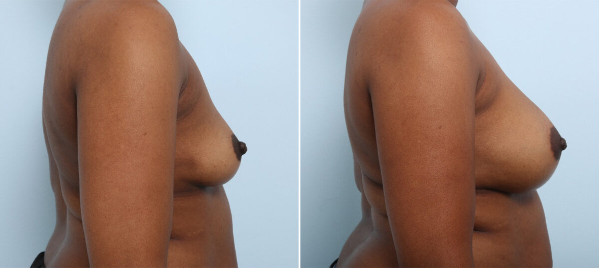 Breast Augmentation before and after photos in Houston, TX, Patient 42912