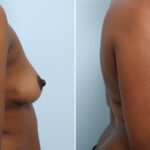 Breast Augmentation before and after photos in Houston, TX, Patient 42912