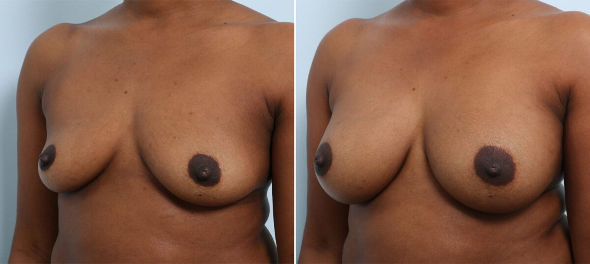 Breast Augmentation before and after photos in Houston, TX, Patient 42912