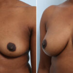 Breast Augmentation before and after photos in Houston, TX, Patient 42912