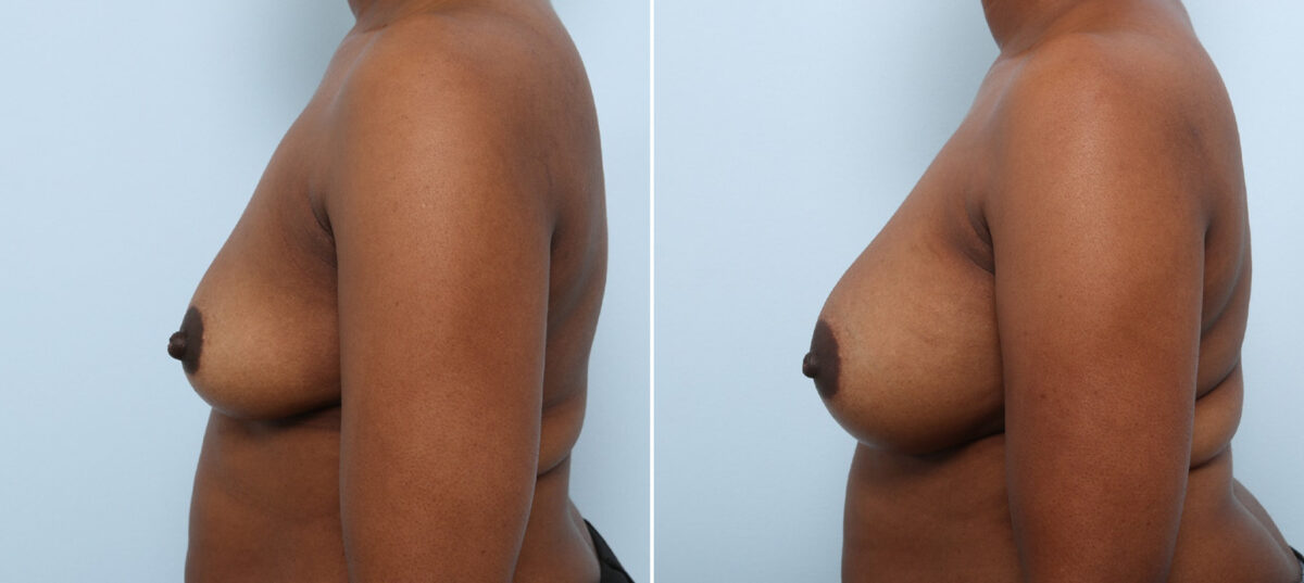 Breast Augmentation before and after photos in Houston, TX, Patient 42912