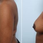 Breast Augmentation before and after photos in Houston, TX, Patient 42912