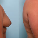 Breast Augmentation before and after photos in Houston, TX, Patient 43267