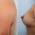 Breast Augmentation before and after photos in Houston, TX, Patient 43286
