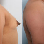 Breast Augmentation before and after photos in Houston, TX, Patient 43286