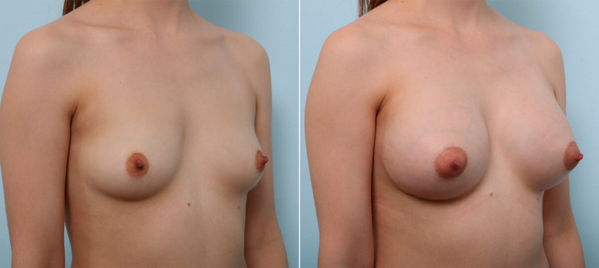 Breast Augmentation before and after photos in Houston, TX, Patient 43513