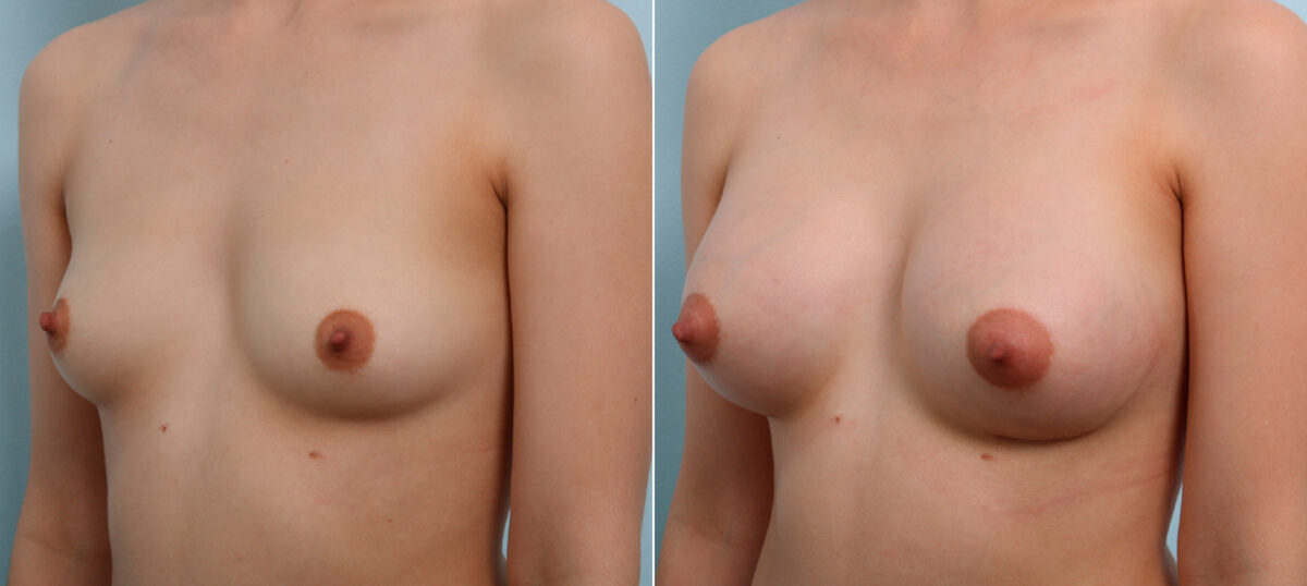 Breast Augmentation before and after photos in Houston, TX, Patient 43513