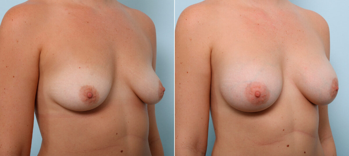 Breast Augmentation before and after photos in Houston, TX, Patient 43978