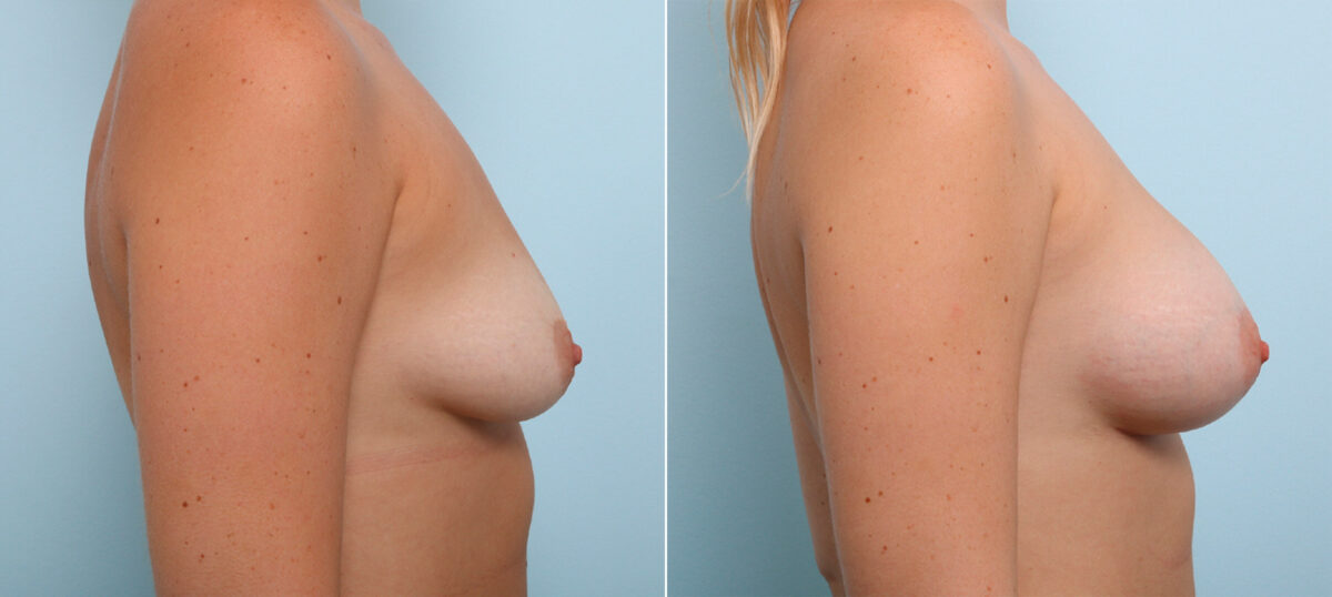 Breast Augmentation before and after photos in Houston, TX, Patient 43978