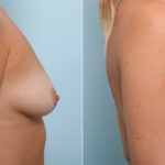 Breast Augmentation before and after photos in Houston, TX, Patient 43978