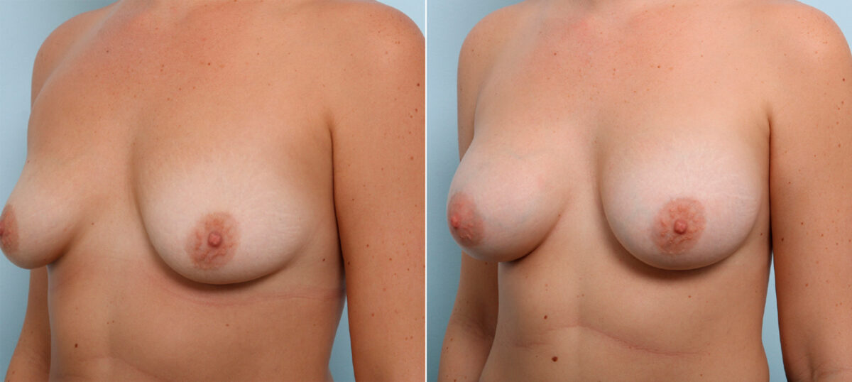 Breast Augmentation before and after photos in Houston, TX, Patient 43978