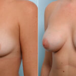 Breast Augmentation before and after photos in Houston, TX, Patient 43978