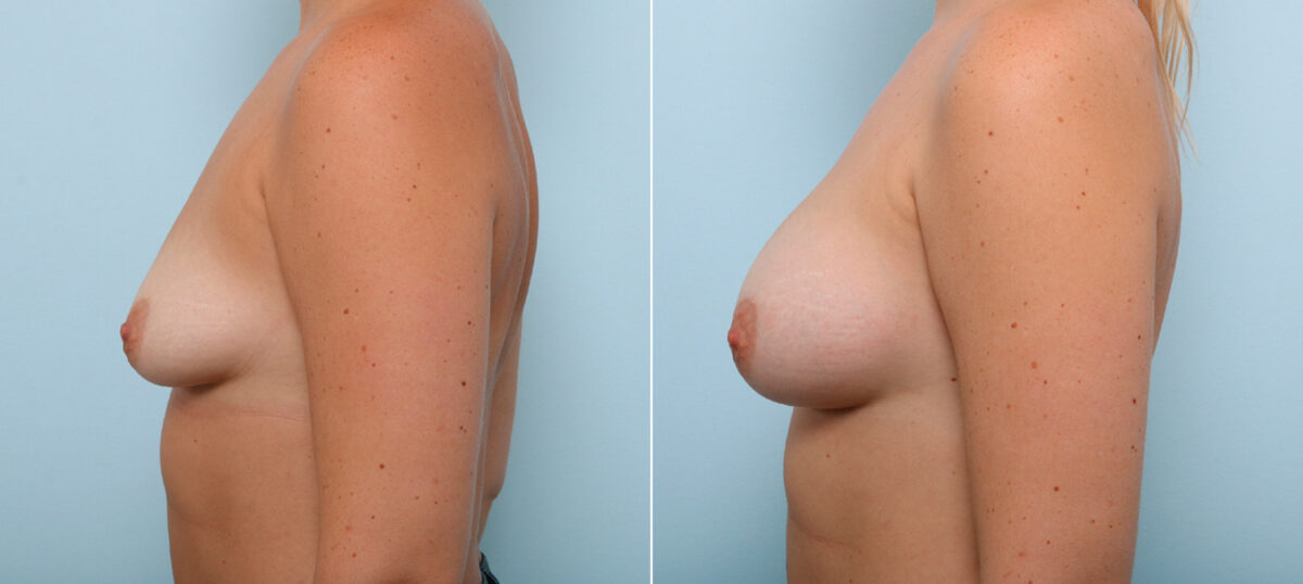 Breast Augmentation before and after photos in Houston, TX, Patient 43978