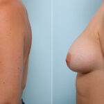 Breast Augmentation before and after photos in Houston, TX, Patient 43978
