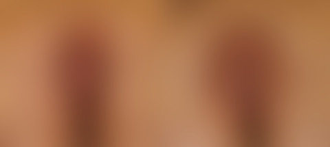 Labiaplasty before and after photos in Houston, TX
