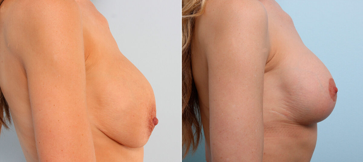 Breast Lift with Augmentation before and after photos in Houston, TX, Patient 47503