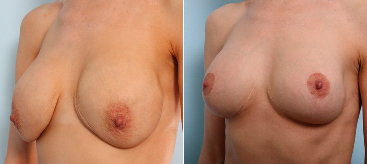 Breast Lift with Augmentation before and after photos in Houston, TX, Patient 47503