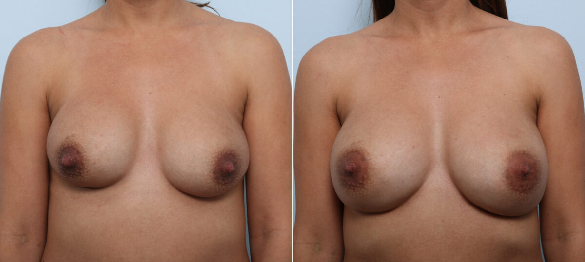 Breast Implant Exchange before and after photos in Houston, TX, Patient 52789