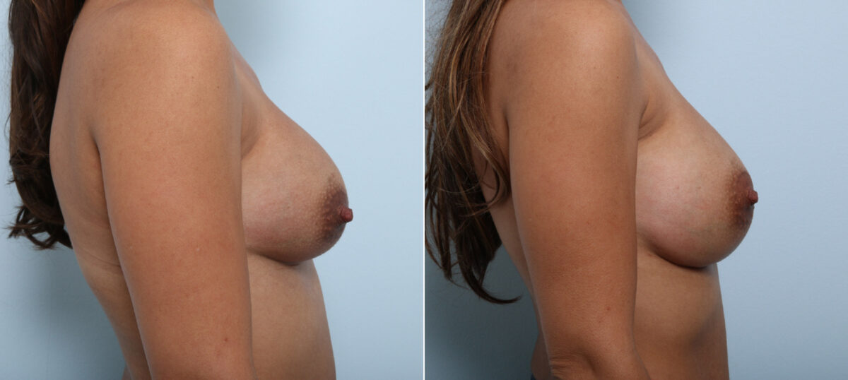 Breast Implant Exchange before and after photos in Houston, TX, Patient 52789