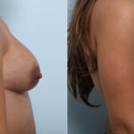 Breast Implant Exchange before and after photos in Houston, TX, Patient 52789