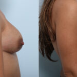 Breast Implant Exchange before and after photos in Houston, TX, Patient 52789