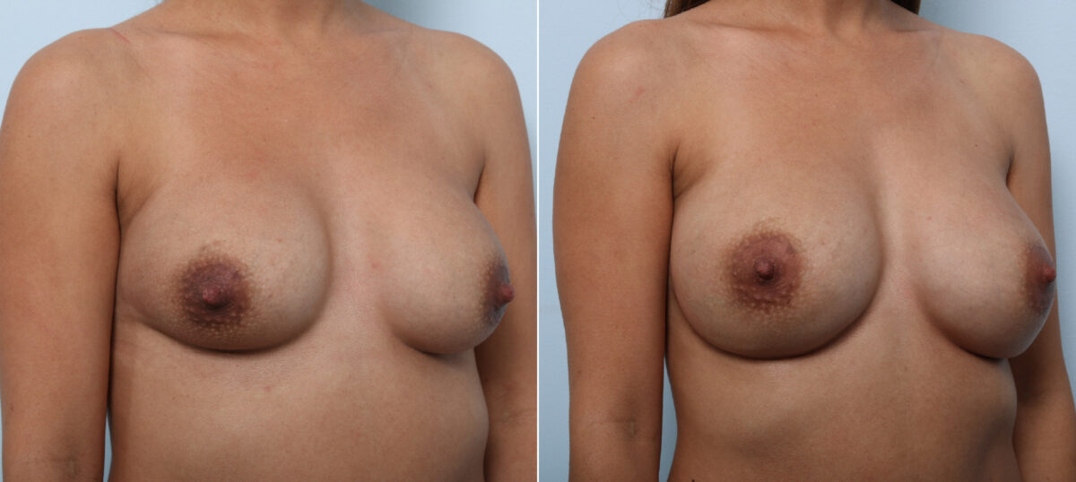 Breast Implant Exchange before and after photos in Houston, TX, Patient 52789