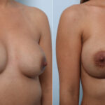 Breast Implant Exchange before and after photos in Houston, TX, Patient 52789