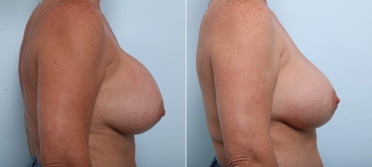 Breast Implant Exchange before and after photos in Houston, TX, Patient 52793