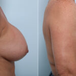 Breast Implant Exchange before and after photos in Houston, TX, Patient 52793