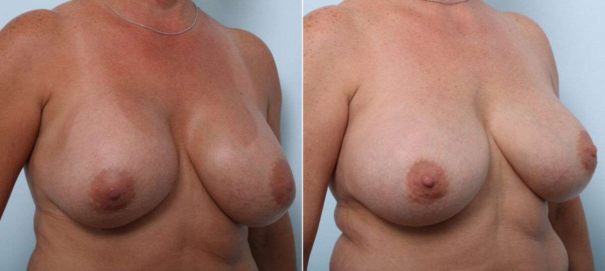 Breast Implant Exchange before and after photos in Houston, TX, Patient 52793