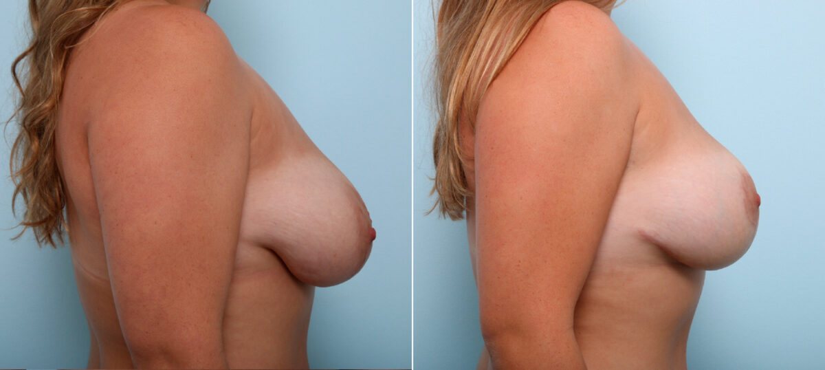 Breast Lift before and after photos in Houston, TX, Patient 54629