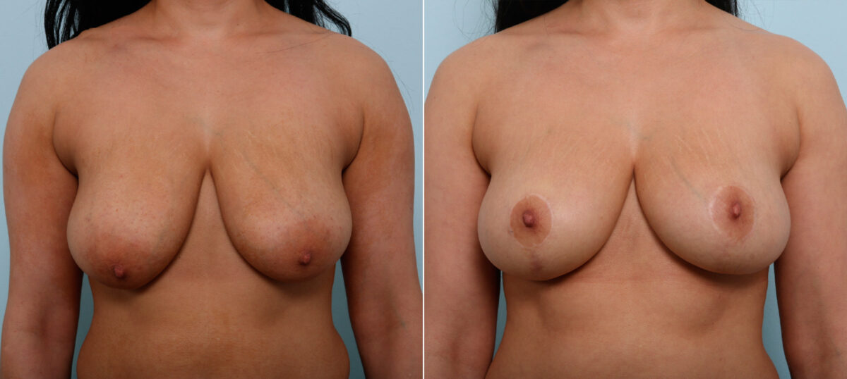 Breast Lift before and after photos in Houston, TX, Patient 54645