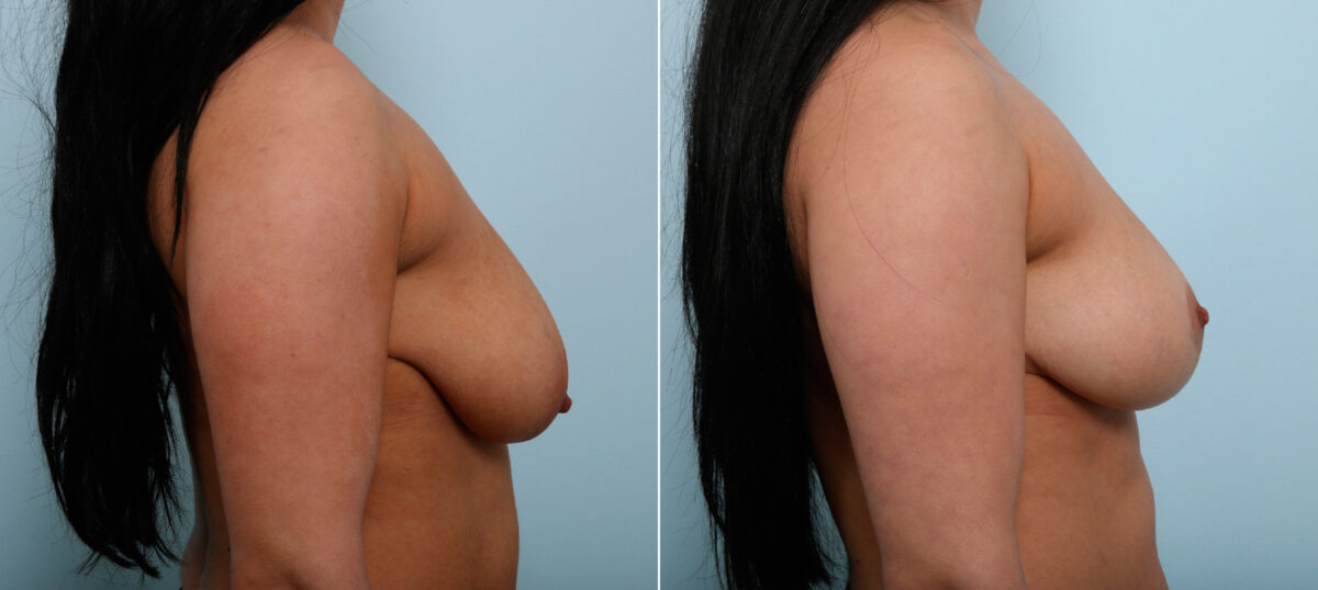 Breast Lift before and after photos in Houston, TX, Patient 54645