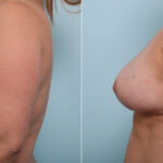 Breast Lift before and after photos in Houston, TX, Patient 54679