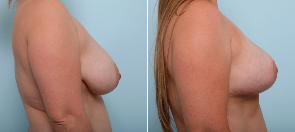 Breast Lift before and after photos in Houston, TX, Patient 54679