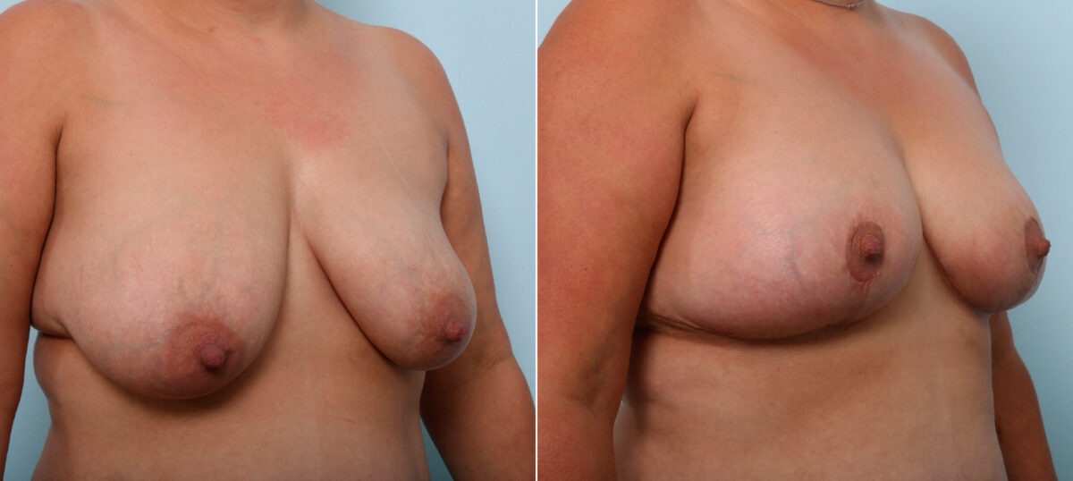 Breast Lift before and after photos in Houston, TX, Patient 54718